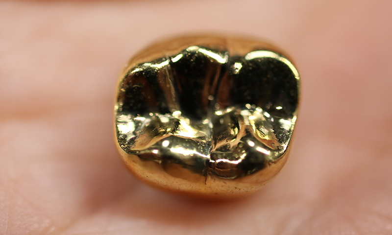金歯